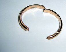 Спасатели помогли снять с пальца кольцо